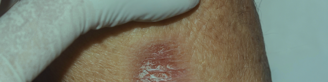 Dermatological wounds