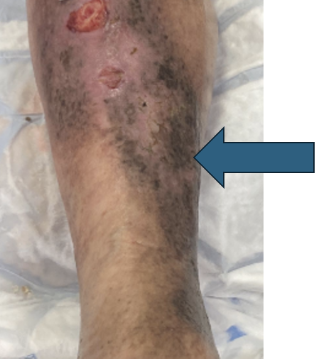 Photo showing skin staining