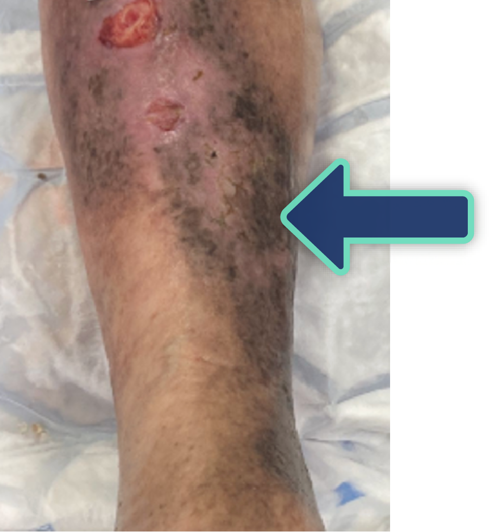 Photo 1 showing skin staining